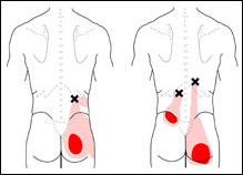  Pain is referred mostly into the buttock all the way from the top of
