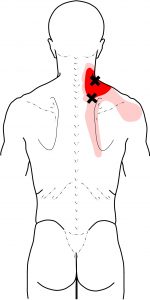 Levator Scapula TrPs