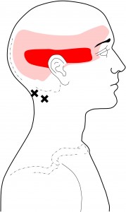 Suboccipital TrPs