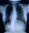 scoliosis-x-ray
