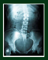 scoliosis-xray4