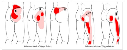 Trigger Points Hip & Back