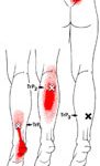 soleus-trps