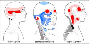 headache-group