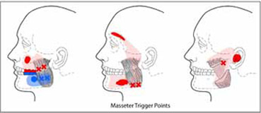 masseter-trps-5