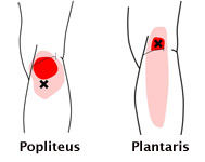 Plantaris Muscle Pain: Strains and Tears