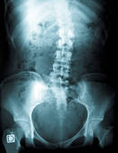 scoliosis-xray