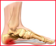 Plantar fasciitis pain: A Neuromuscular Therapy point of view – Christina's  Pain Therapy Blog