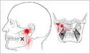 medpterygoid2