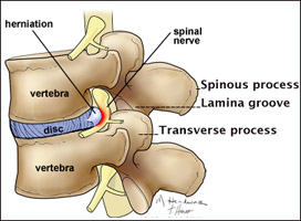 Lateral view of a herniated lumbar disc compressing a spinal ner