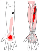 palmaris-longus-trp